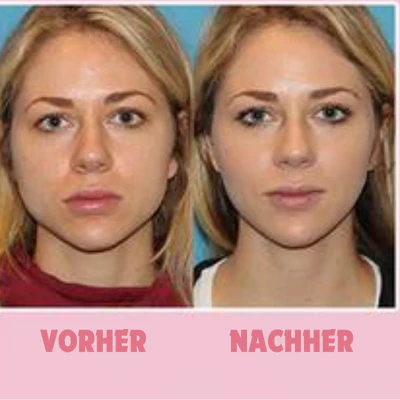 GesichtForm™ Definierende Kieferlinie Optimierung - Image 2